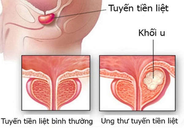Chị em thấy chồng có 3/5 dấu hiệu này nên khuyên đi khám kẻo ung thư để lâu khó chữa - Ảnh 1 Chị em thấy chồng có 3/5 dấu hiệu này nên khuyên đi khám kẻo ung thư để lâu khó chữa - Ảnh 1