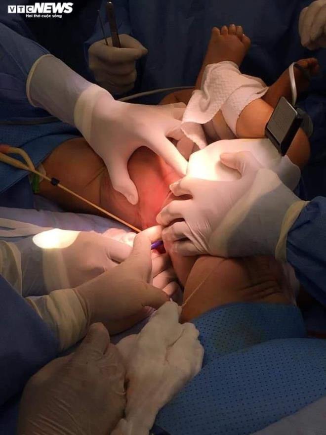 Ảnh: Khoảnh khắc t&aacute;ch rời cặp song sinh d&iacute;nh liền - 6