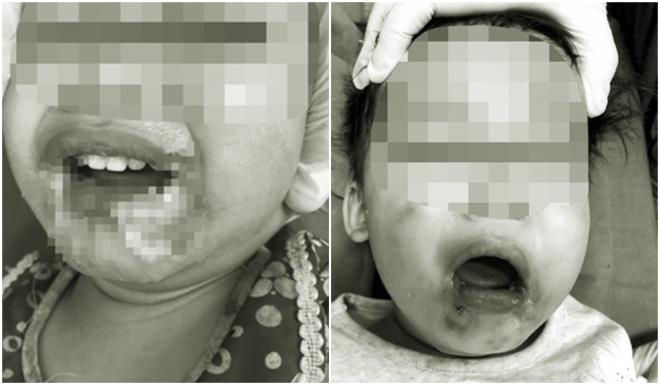 Cắn dây điện khi ngồi chơi, bé gái 2 tuổi ở Yên Bái bất tỉnh, nhập viện khẩn cấp - 1