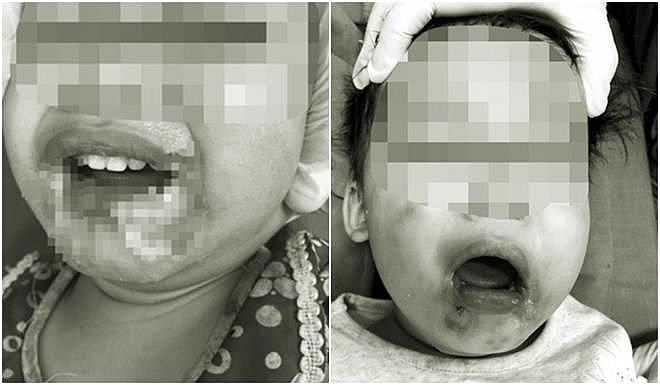 Cắn dây điện khi ngồi chơi, bé gái 2 tuổi ở Yên Bái bất tỉnh, nhập viện khẩn cấp