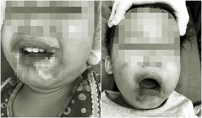 Cắn dây điện khi ngồi chơi, bé gái 2 tuổi ở Yên Bái bất tỉnh, nhập viện khẩn cấp