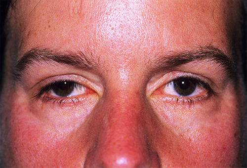 Các bất thường nhỏ trên gương mặt hé lộ các bệnh nguy hiểm - Ảnh 5 Các bất thường nhỏ trên gương mặt hé lộ các bệnh nguy hiểm - Ảnh 5