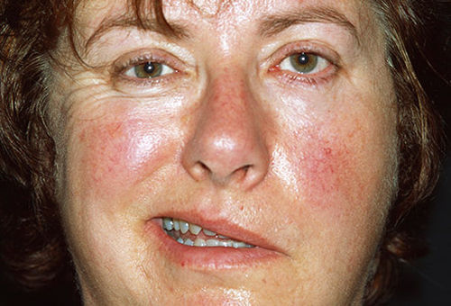 Các bất thường nhỏ trên gương mặt hé lộ các bệnh nguy hiểm - Ảnh 6 Các bất thường nhỏ trên gương mặt hé lộ các bệnh nguy hiểm - Ảnh 6