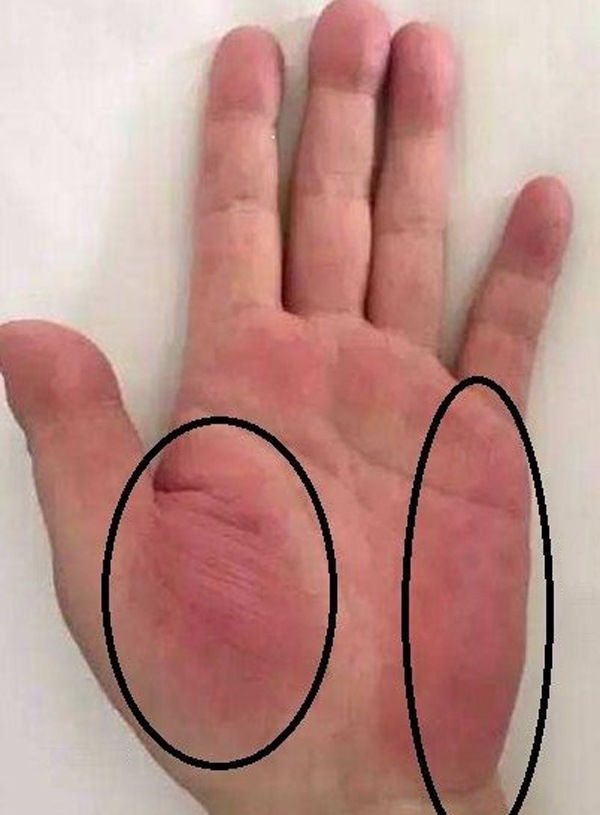 3 dấu hiệu trên tay cảnh báo sớm ung thư gan, có 1 trong 3 cũng nên kiểm tra sớm - Ảnh 3 3 dấu hiệu trên tay cảnh báo sớm ung thư gan, có 1 trong 3 cũng nên kiểm tra sớm - Ảnh 3